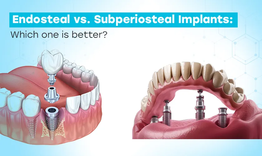 Endosteal vs Subperiosteal Implants: Which one is better?