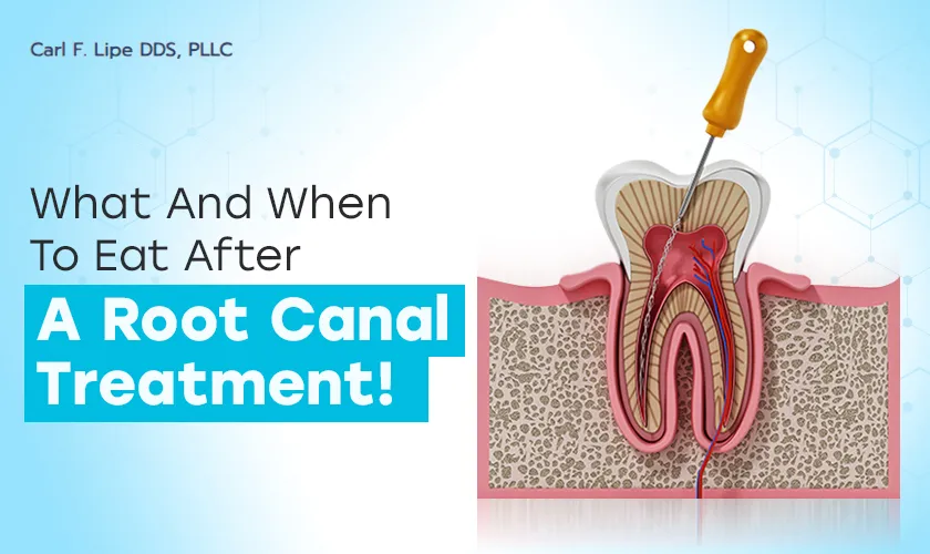 Healing After a Root Canal: What to Eat & What to Avoid After Root Canal Treatment